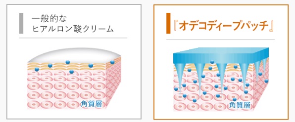 オデコディープパッチのヒアルロン酸注入